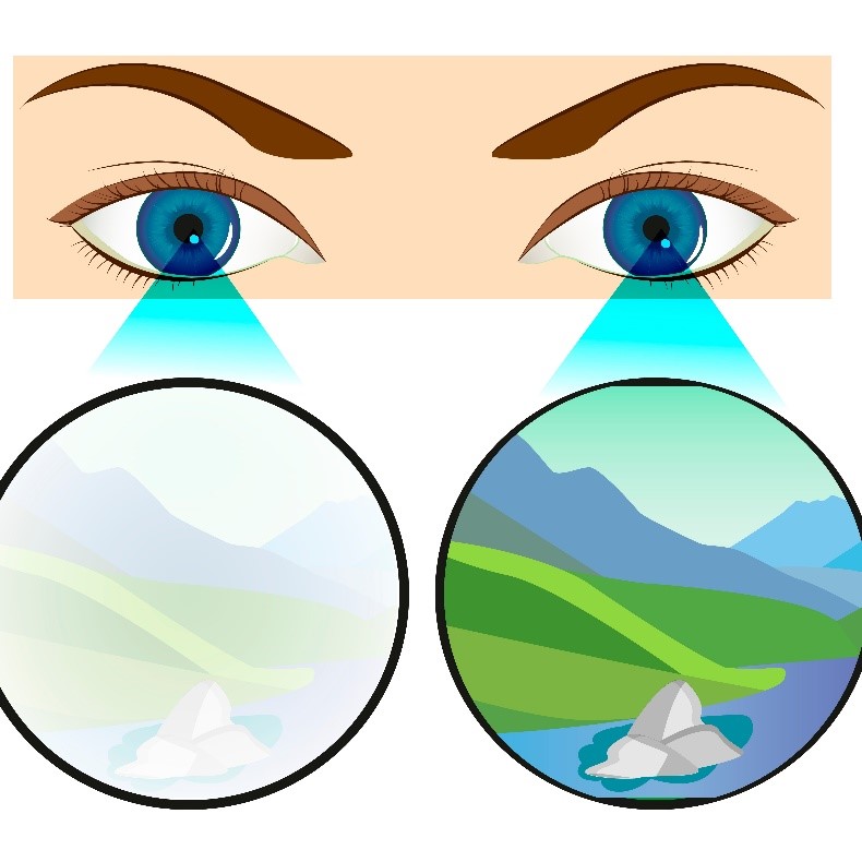 Εικ.1 Αμβλυωπία δεξιού οφθαλμού